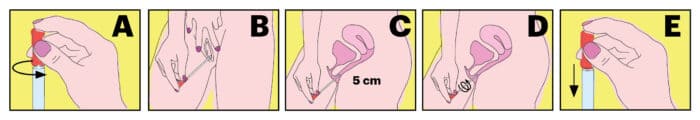 The picture explains how to take your sample for fungal vaginitis.